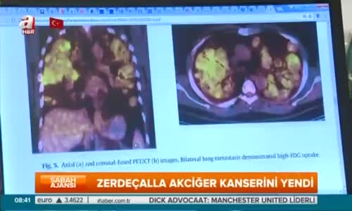 Akciğer Kanserini Zerdeçal İle Yendi Dünya Tıp Tarihine Geçti