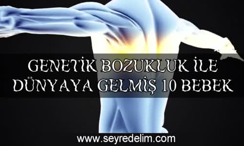 Genetik Bozukluk ile Dünyaya Gelmiş 10 Bebek