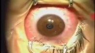 Göz Ameliyatı 